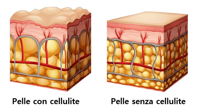 Cellulite-grasso-localizzato-stratificato-pearl'age-cosmetic